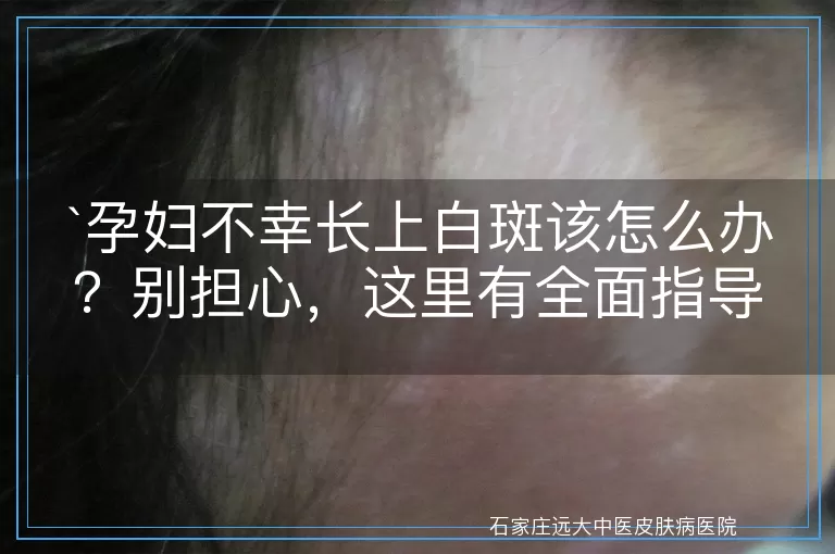 孕妇不幸长上白斑该怎么办？别担心，这里有全面指导