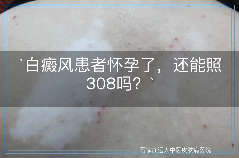 白癜风患者怀孕了，还能照308吗？
