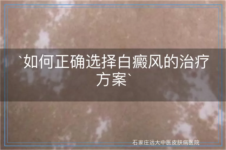 如何正确选择白癜风的治疗方案