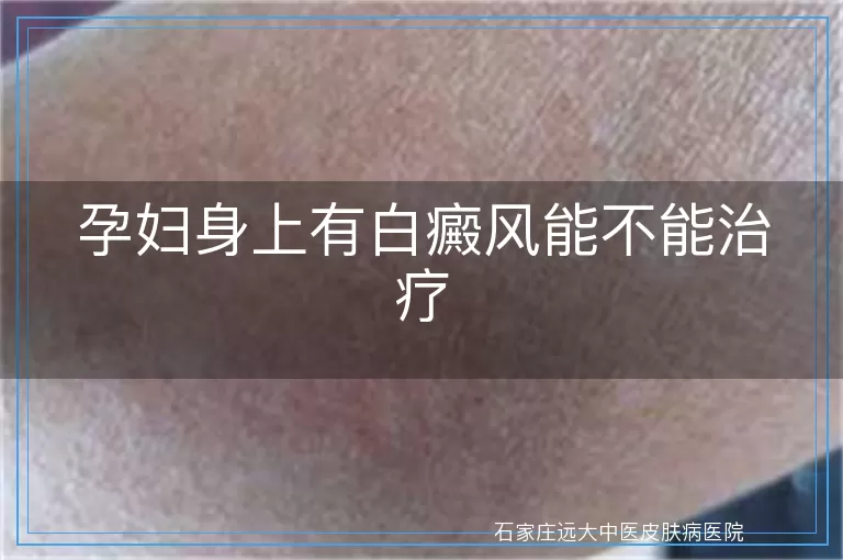 孕妇身上有白癜风能不能治疗