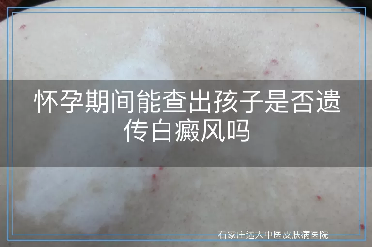 怀孕期间能查出孩子是否遗传白癜风吗