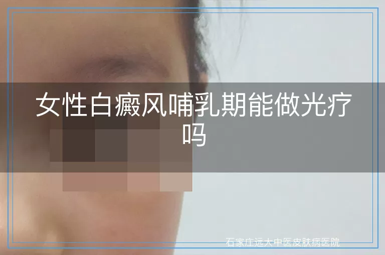 女性白癜风哺乳期能做光疗吗