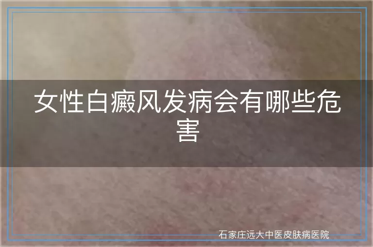 女性白癜风发病会有哪些危害