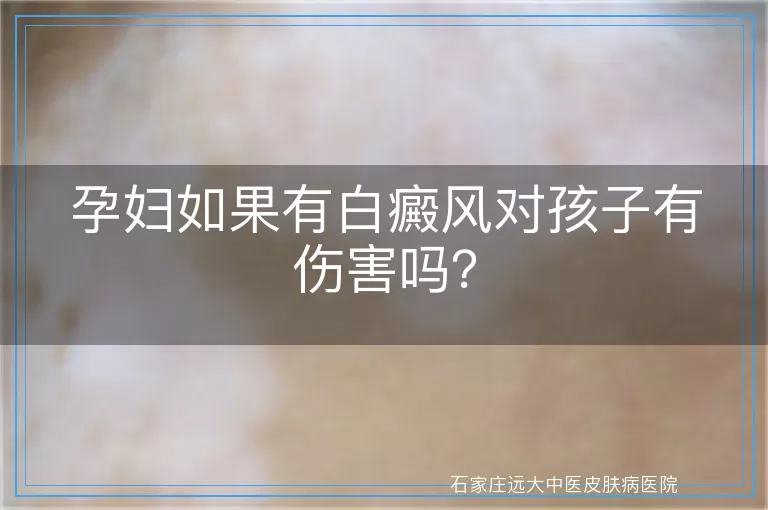 孕妇如果有白癜风对孩子有伤害吗？