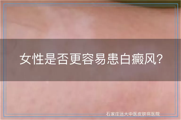 女性是否更容易患白癜风？