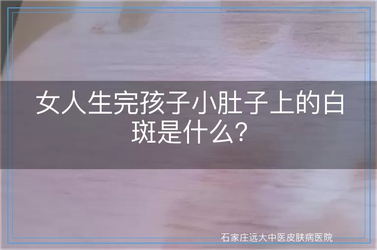女人生完孩子小肚子上的白斑是什么？