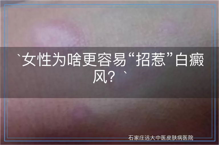 女性为啥更容易“招惹”白癜风？