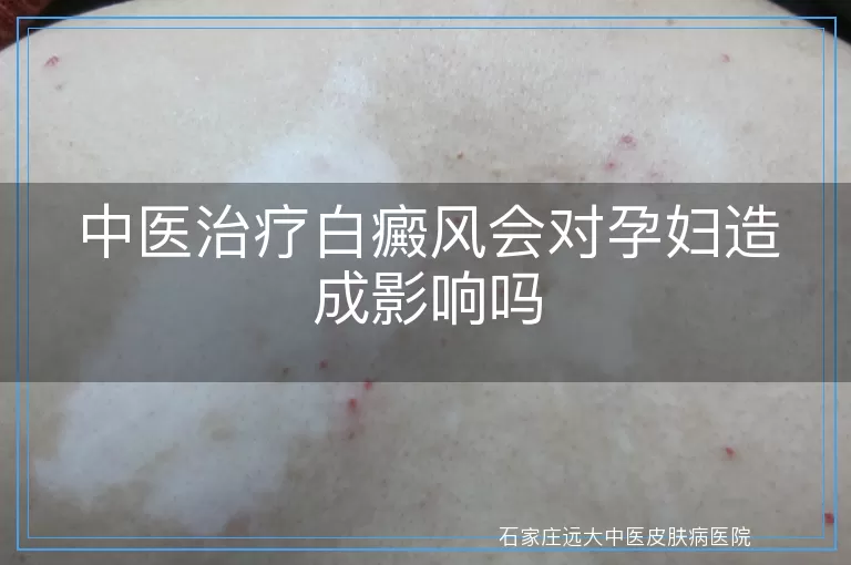 中医治疗白癜风会对孕妇造成影响吗
