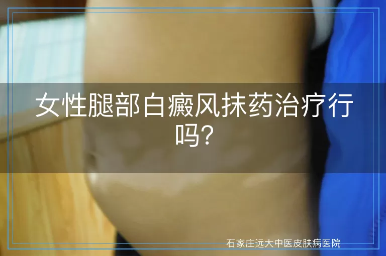 女性腿部白癜风抹药治疗行吗？