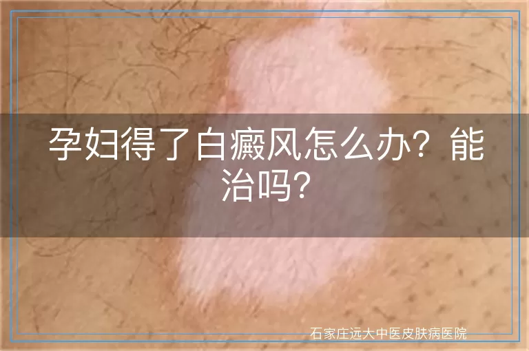 孕妇得了白癜风怎么办？能治吗？