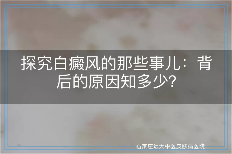探究白癜风的那些事儿：背后的原因知多少？
