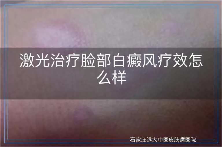 激光治疗脸部白癜风疗效怎么样