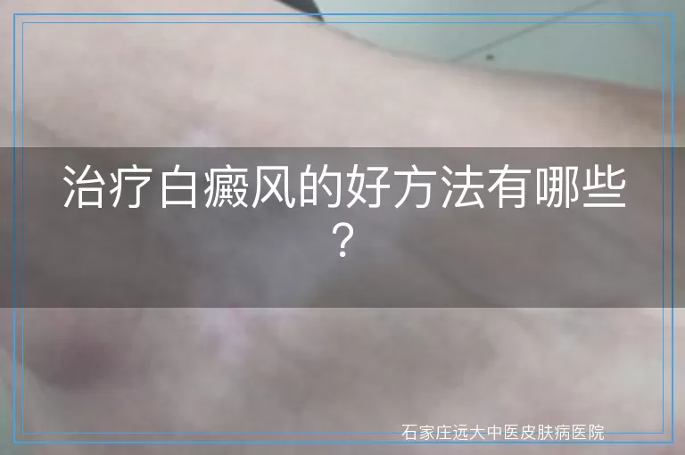 治疗白癜风的好方法有哪些？