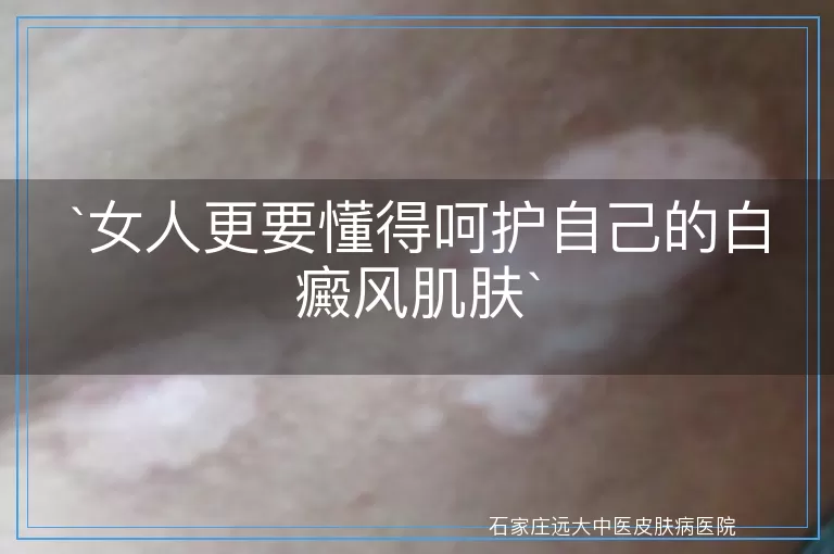女人更要懂得呵护自己的白癜风肌肤