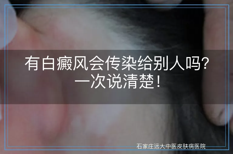 有白癜风会传染给别人吗？一次说清楚！