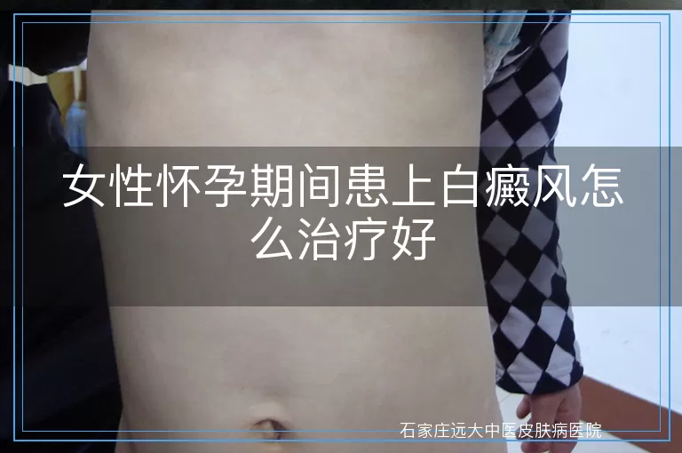 女性怀孕期间患上白癜风怎么治疗好