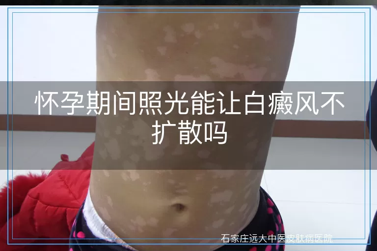 怀孕期间照光能让白癜风不扩散吗