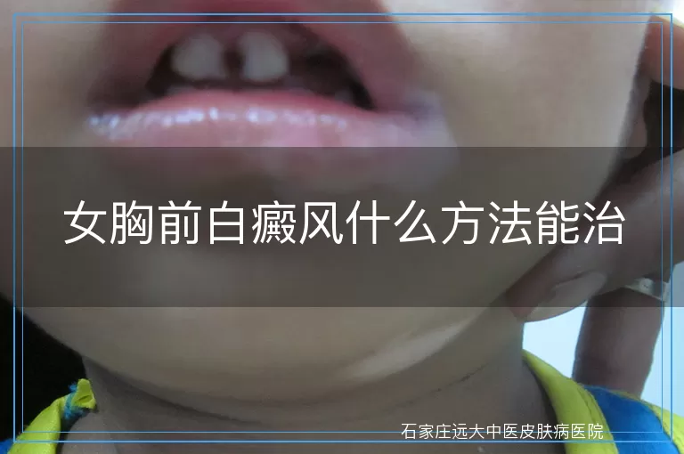 女胸前白癜风什么方法能治