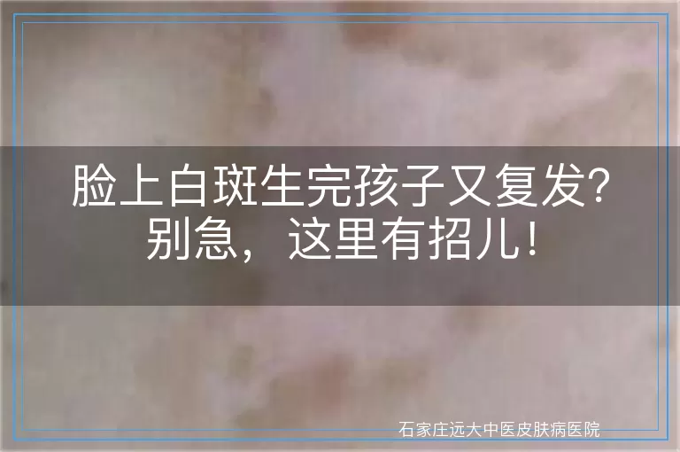 脸上白斑生完孩子又复发？别急，这里有招儿！