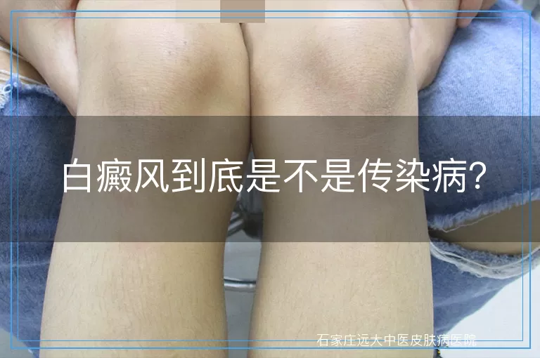 白癜风到底是不是传染病？