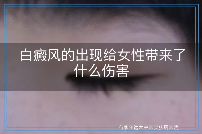白癜风的出现给女性带来了什么伤害