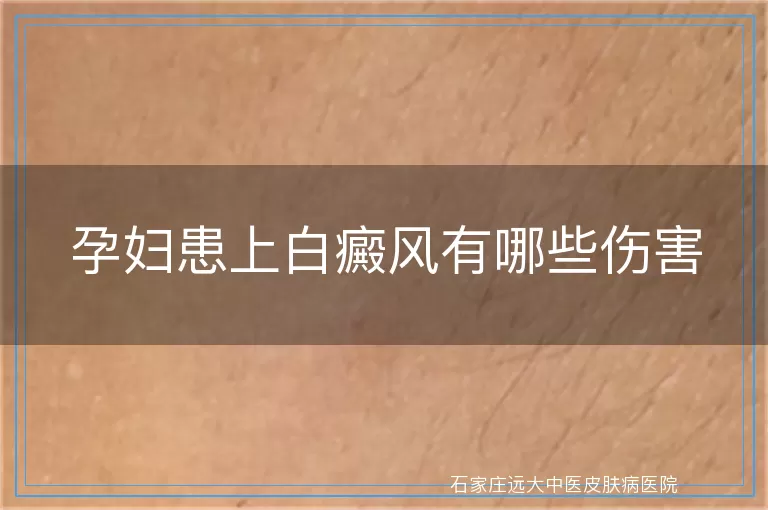 孕妇患上白癜风有哪些伤害