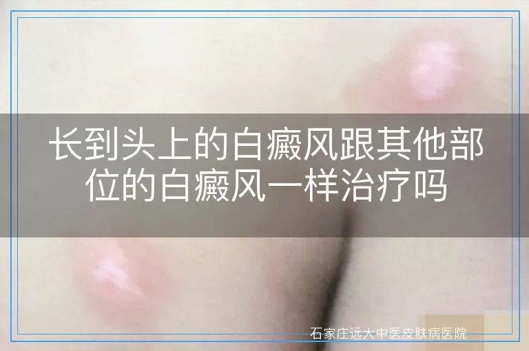 长到头上的白癜风跟其他部位的白癜风一样治疗吗