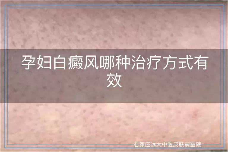 孕妇白癜风哪种治疗方式有效