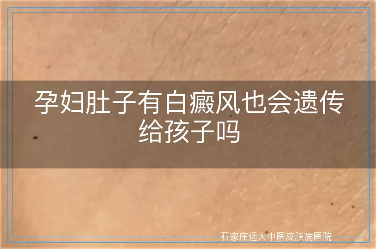 孕妇肚子有白癜风也会遗传给孩子吗