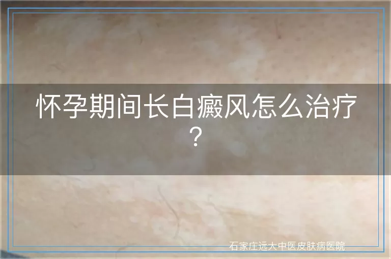 怀孕期间长白癜风怎么治疗？