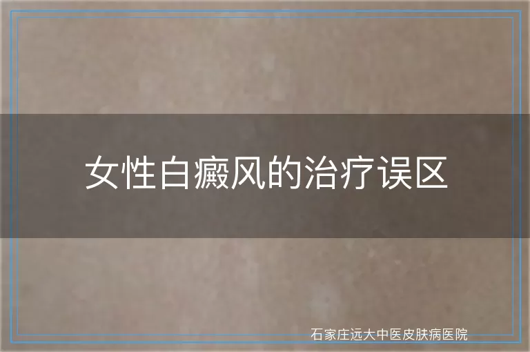 女性白癜风的治疗误区