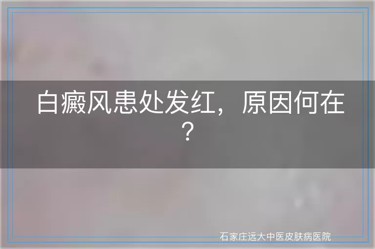 白癜风患处发红，原因何在？