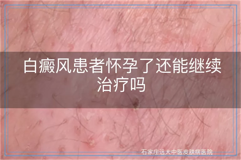 白癜风患者怀孕了还能继续治疗吗