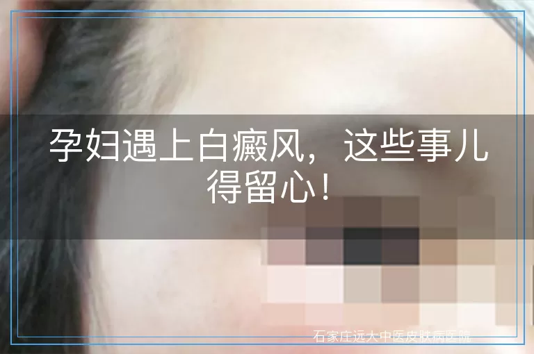 孕妇遇上白癜风，这些事儿得留心！