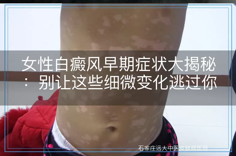 女性白癜风早期症状大揭秘：别让这些细微变化逃过你的眼！