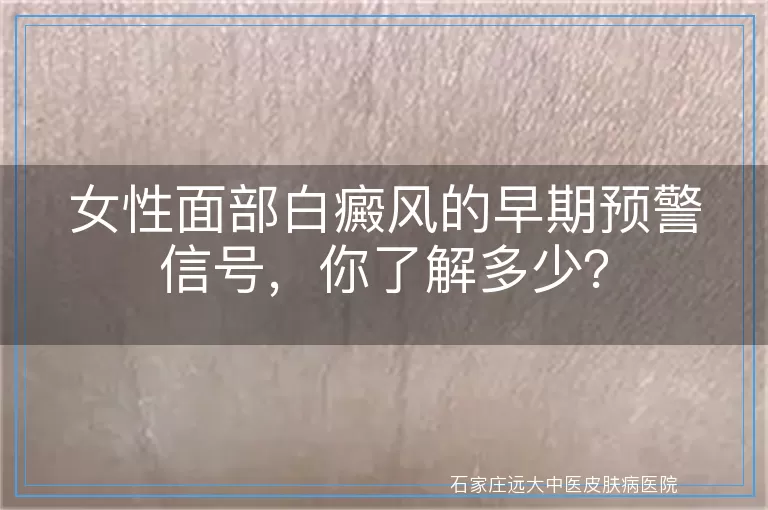 女性面部白癜风的早期预警信号，你了解多少？