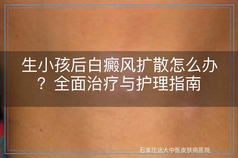 生小孩后白癜风扩散怎么办？全面治疗与护理指南