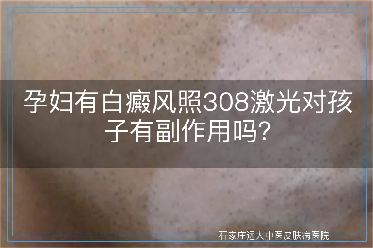 孕妇有白癜风照308激光对孩子有副作用吗？