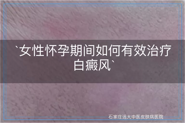 女性怀孕期间如何有效治疗白癜风