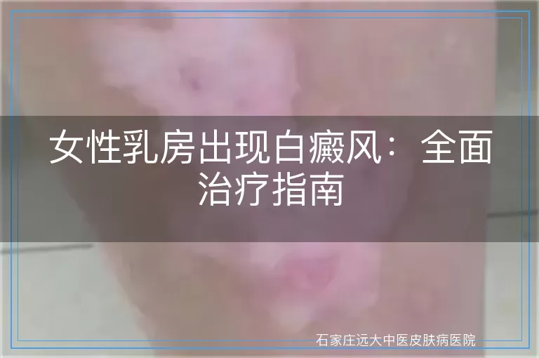 女性乳房出现白癜风：全面治疗指南