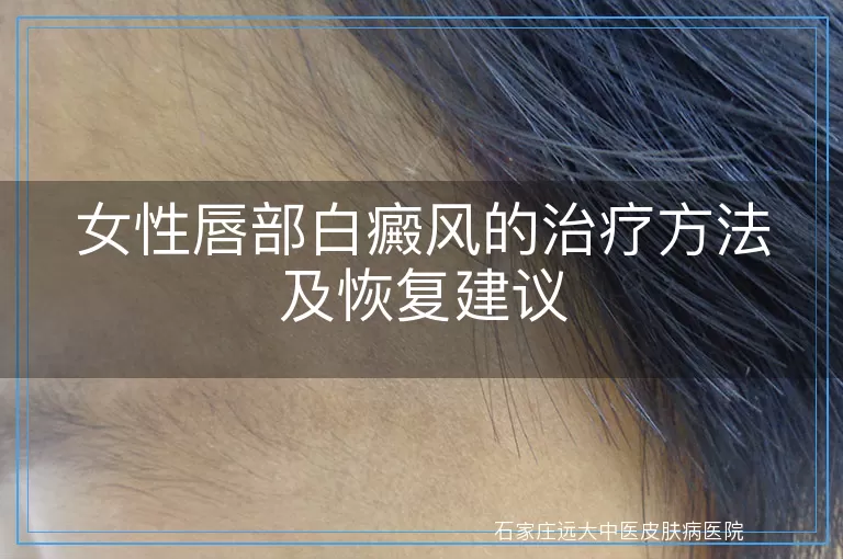 女性唇部白癜风的治疗方法及恢复建议
