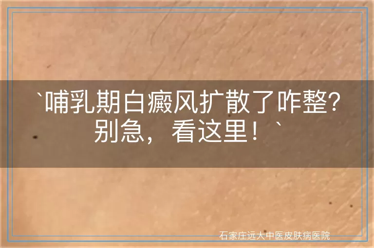 哺乳期白癜风扩散了咋整？别急，看这里！