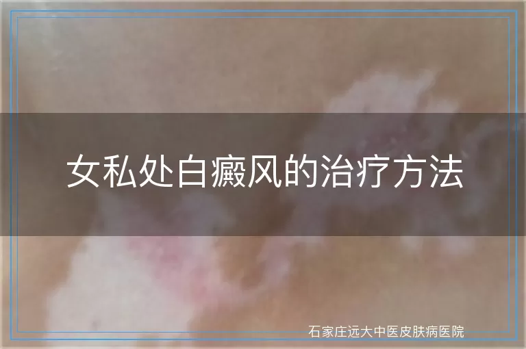 女私处白癜风的治疗方法
