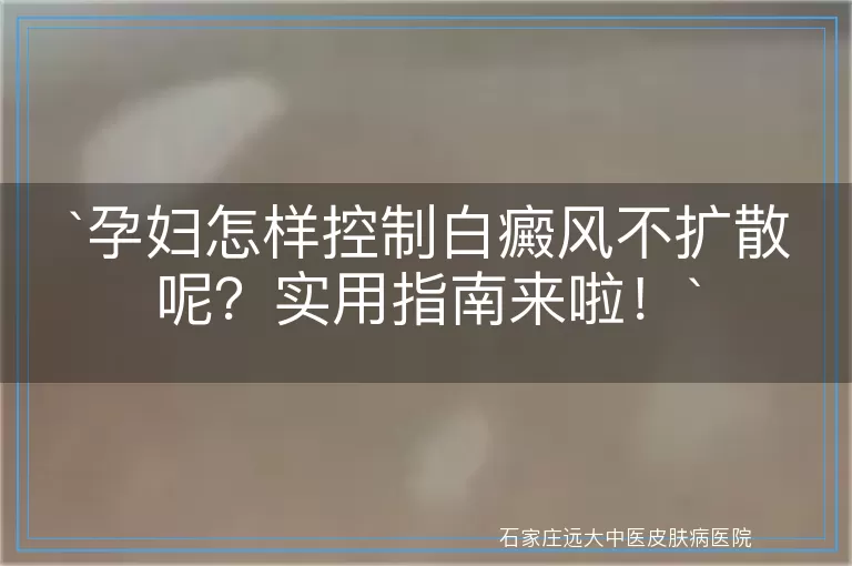 孕妇怎样控制白癜风不扩散呢？实用指南来啦！