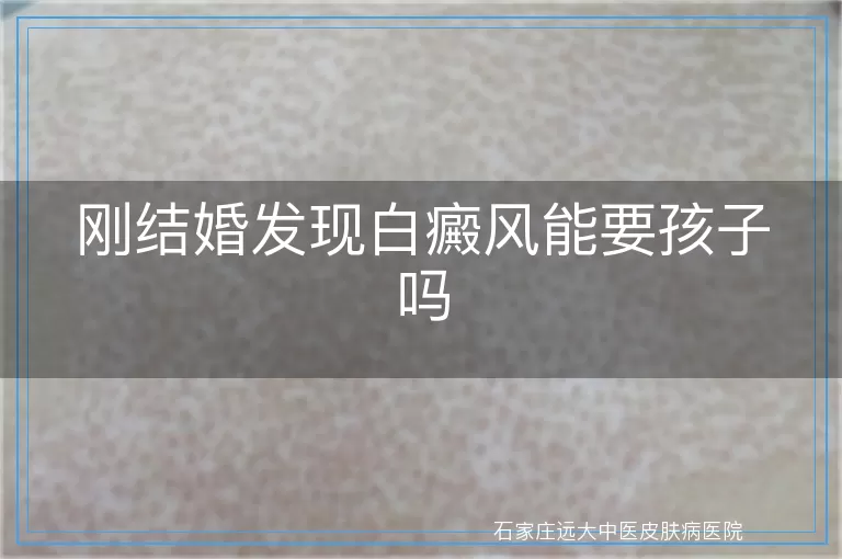 刚结婚发现白癜风能要孩子吗