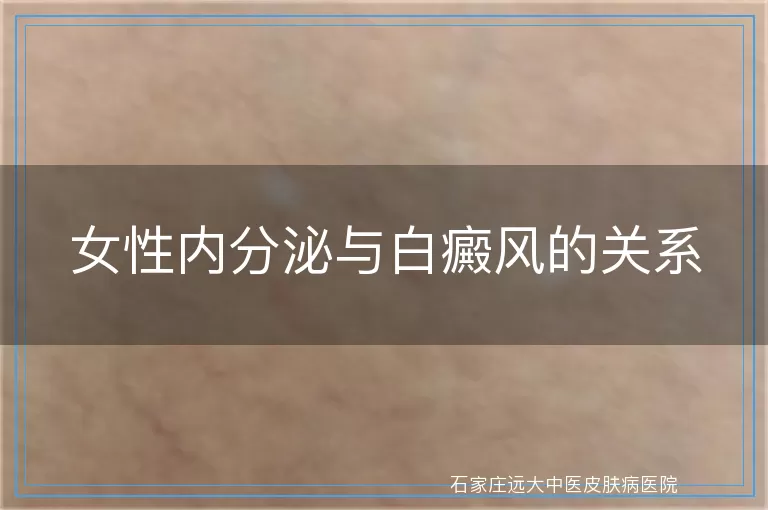 女性内分泌与白癜风的关系