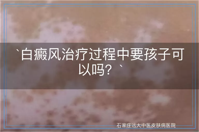 白癜风治疗过程中要孩子可以吗?