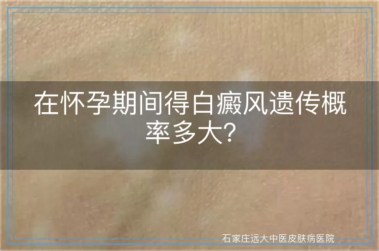 在怀孕期间得白癜风遗传概率多大？