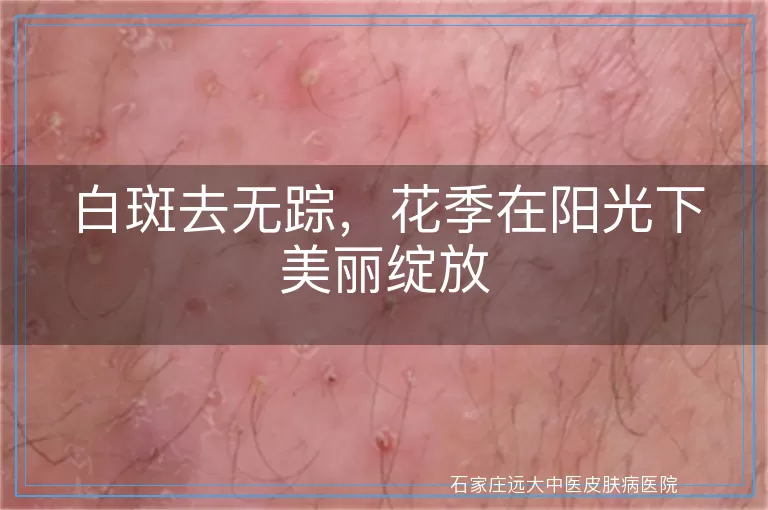白斑去无踪，花季在阳光下美丽绽放