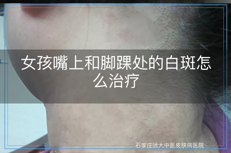 女孩嘴上和脚踝处的白斑怎么治疗